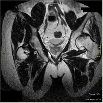 МРТ левого тазобедренного сустава после лечения (2010 г.)