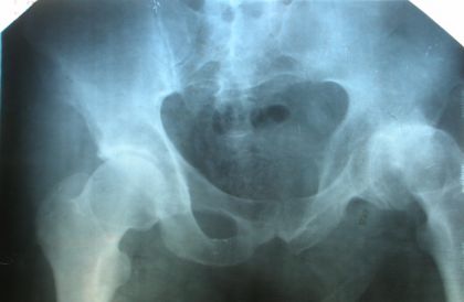 Рентгеновский снимок левого тазобедренного сустава до лечения (2004 г.)
